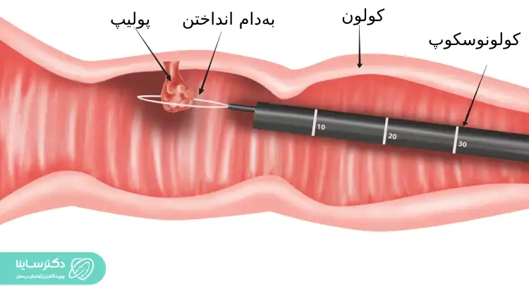 کولونوسکوپی چیست
