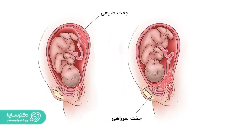 با داشتن جفت سرراهی از خودارضایی در دوران بارداری خودداری کنید
