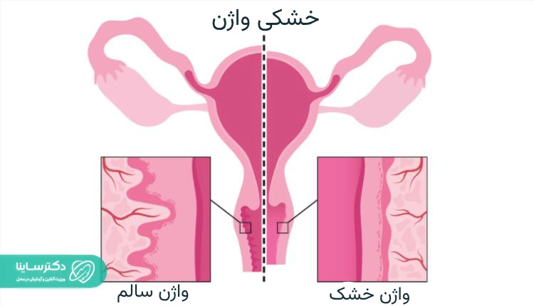 خشکی واژن
