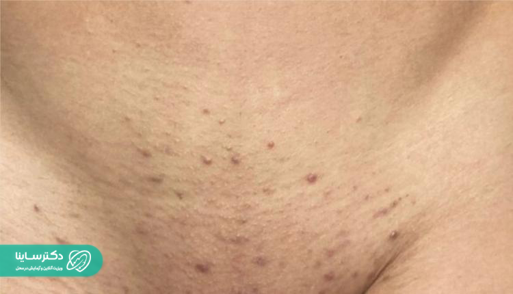 جوش واژن ناشی از اصلاح موهای ناحیه تناسلی