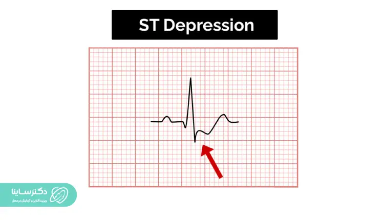 قطعه ST پایین