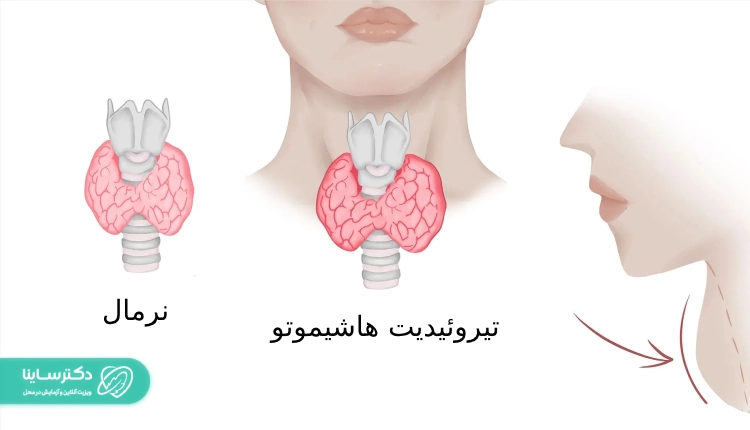 تفاوت تیروئیدیت هاشیموتو با نرمال