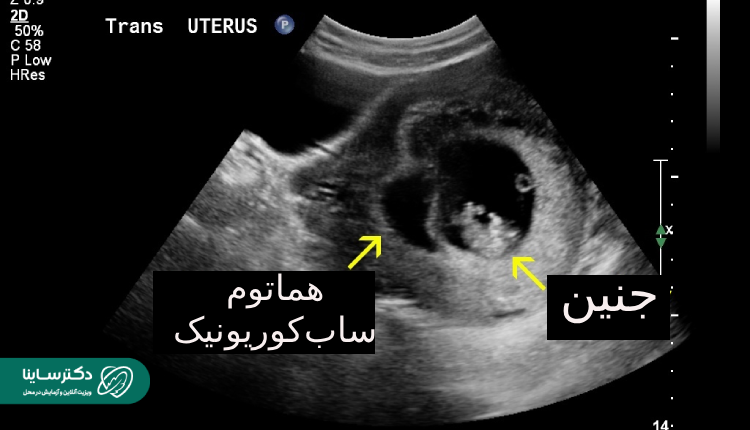 هماتوم در بارداری