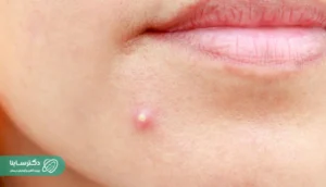 Close-up of a small, pus-filled boil on the skin near the chin, showing early signs of localized skin infection.