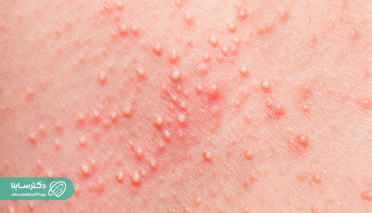 افراد دیابتی بیشتر به کورک مبتلا میشوند