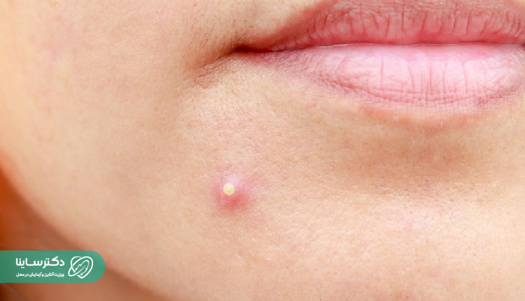 Close-up of a small, pus-filled boil on the skin near the chin, showing early signs of localized skin infection.