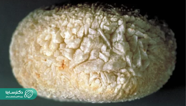 سنگ کلیه اسیداوریک