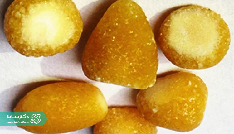 سنگ کلیه سیستئین