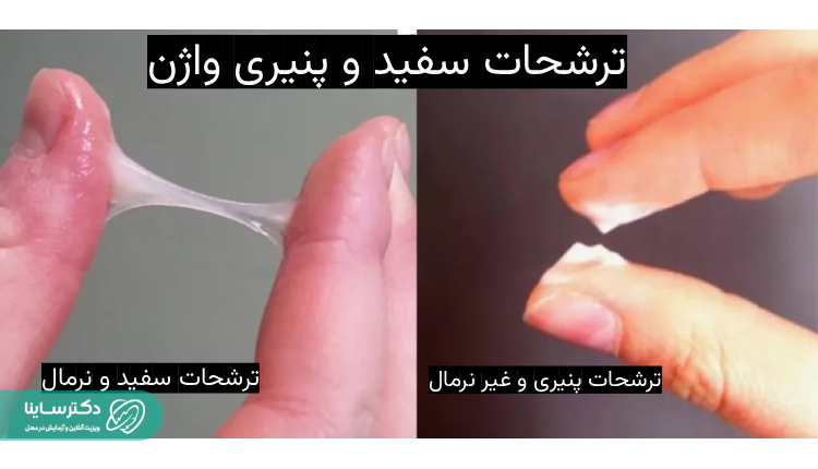 ۲. ترشحات پنیری واژن