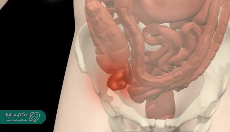 آپاندیس در سمت راست یا چپ؟