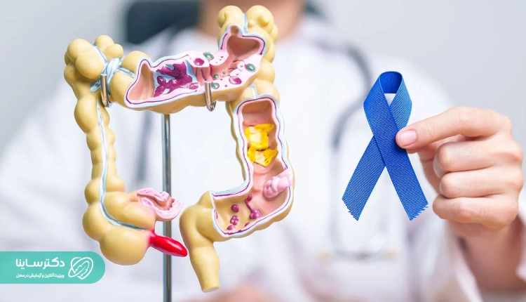 مراحل سرطان روده