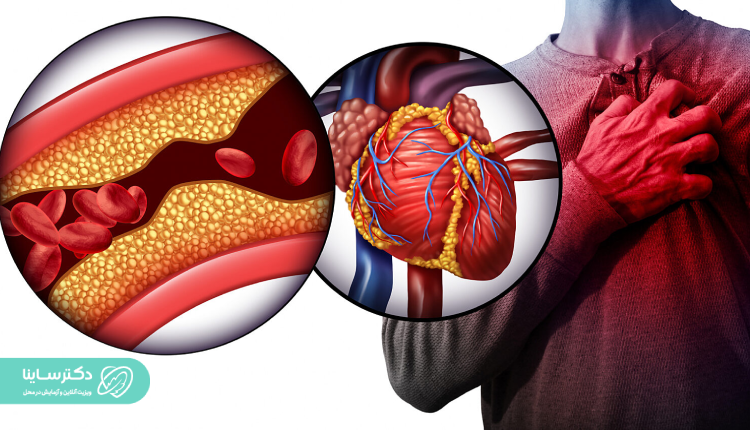 نشانهها و علائم شایع سکته قلبی