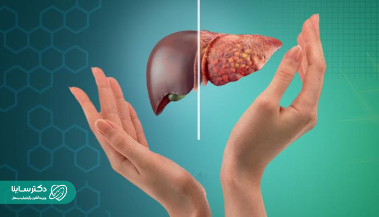 علائم کبد چرب-بیماری کبد چرب مرتبط با اختلالات متابولیک (MASLD)