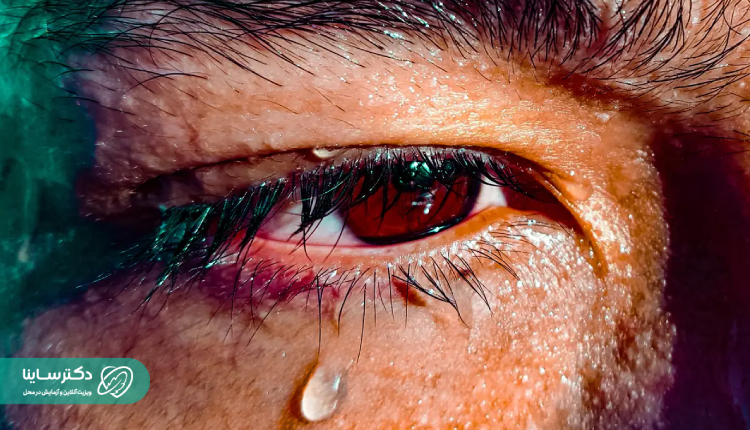 دلایل تعریق بیش از حد سر و صورت