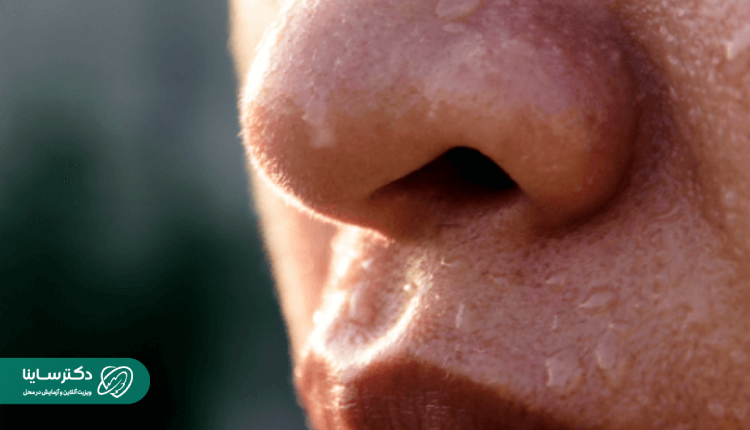 دلیل عرق زیاد صورت و سر