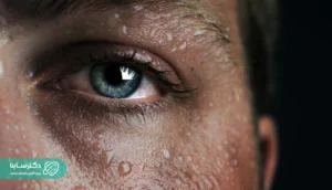 علت عرق زیاد سر و صورت