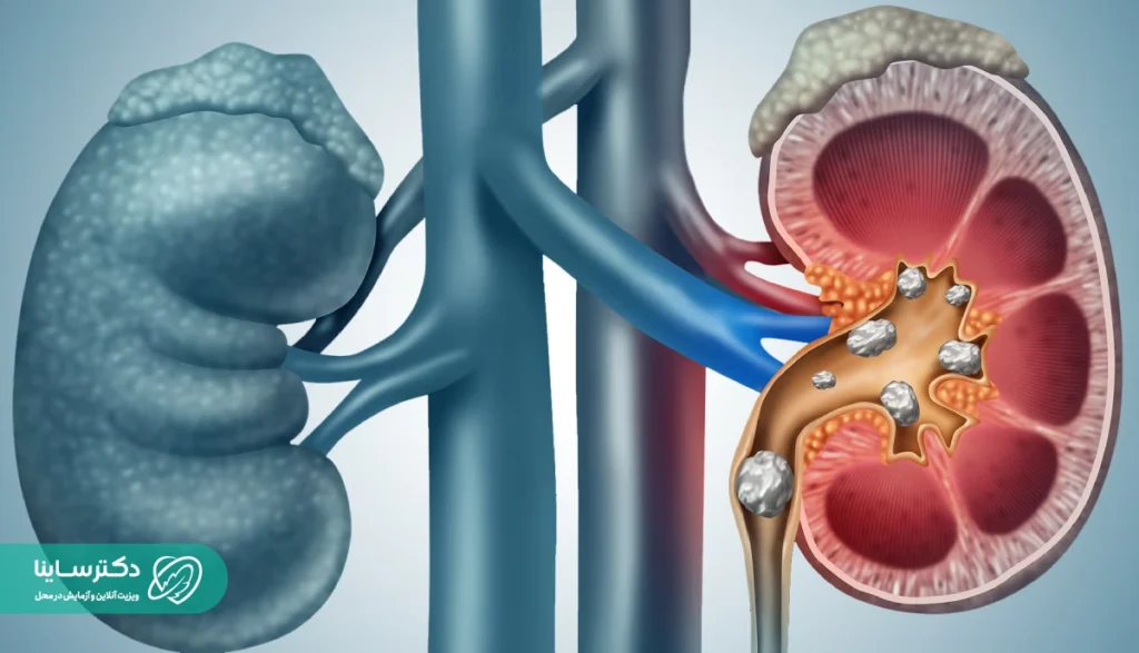 سنگ کلیه چیست؟