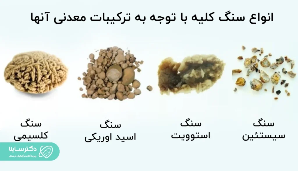 انواع سنگ کلیه