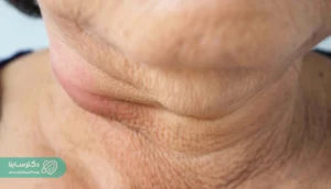 همه‌چیز درباره علائم سرطان غدد لنفاوی گردن