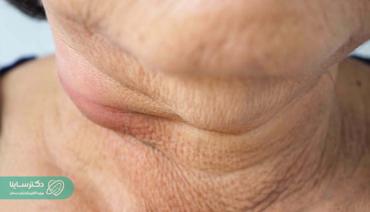 همه‌چیز درباره علائم سرطان غدد لنفاوی گردن