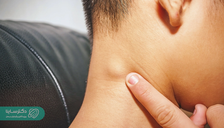 نشانه سرطان غدد لنفاوی در گردن